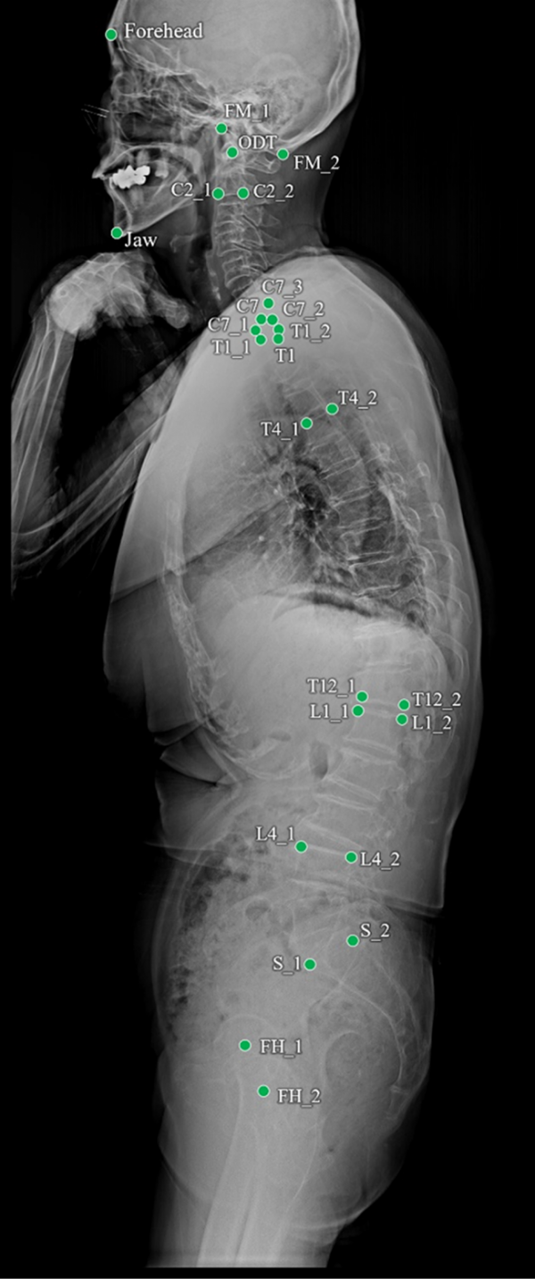 ▲  측면 전척추 X-ray 영상에서 딥러닝 시스템이 찍은 랜드마크(기준점) 모습. (사진제공=아주대학교병원)