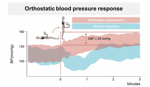 ▲기립성 혈압 변동 검사. 누워있을 때 혈압보다 기립 후 3분 뒤 수축기 혈압이 20mmHg 이상 증가할 경우 기립성 고혈압으로 진단할 수 있다. (사진제공=분당서울대병원)