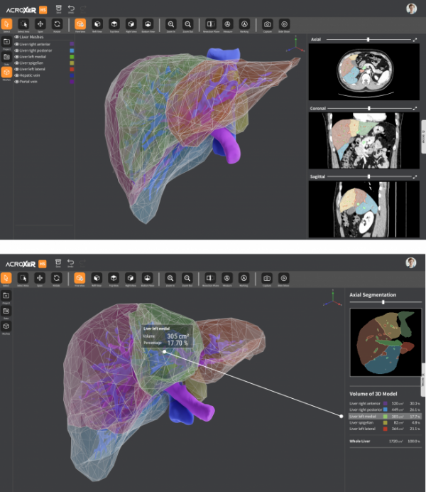 ▲간이식 AI 모델을 탑재한 수술계획 소프트웨어 구동장면. 환자 CT 영상(위 그림 오른쪽)을 바탕으로 환자의 간을 그대로 모사해 3D 이미지(위 그림 왼쪽)로 만든 다음, 간의 세부 구획별 크기와 용적률 등을 자동으로 측정해 의료진에게 안내가 가능하다.(아래 그림) (사진제공=삼성서울병원)