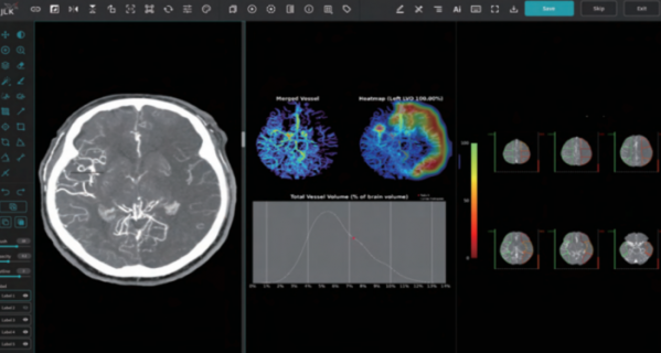 ▲제이엘케이의 대혈관폐색 검출용 AI 솔루션(JLK-LVO) 화면. (사진제공=제이엘케이)