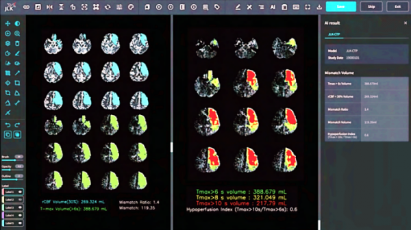 ▲제이엘케이의 뇌 관류영상 분석 AI 솔루션 JLK-CTP 화면. (사진제공=제이엘케이)
