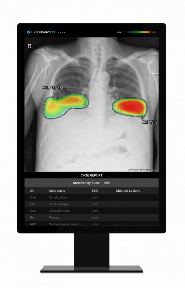 ▲Lunit INSIGHT CXR. (사진제공=루닛)