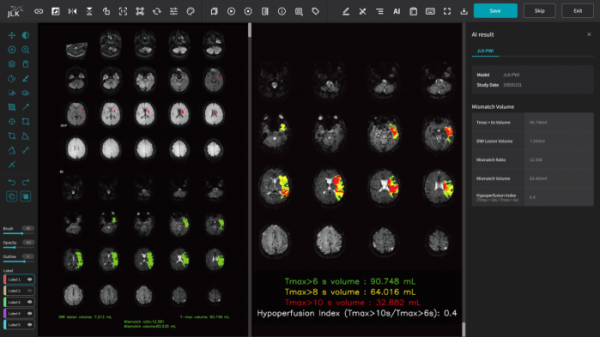 ▲제이엘케이 뇌관류 MR 영상 분석 솔루션(JLK-PWI) 구동 화면. (사진제공=제이엘케이)
