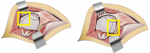 ▲관절낭 위쪽을 절개하는 기존 수술법(좌), 관절낭 아래쪽을 절개하는 파이코 수술법(우) (사진제공=분당서울대병원)