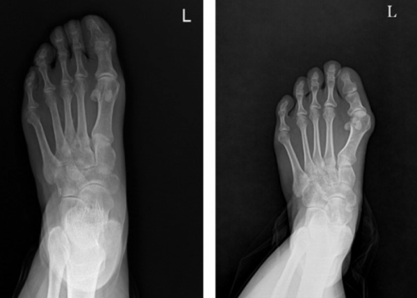 ▲정상 발(왼쪽)과 무지외반증 발의 엑스레이(X-ray) 사진 (사진제공=바른세상병원)