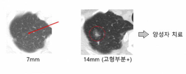 ▲2002년 저선량 흉부 CT 검사에서 7mm 크기의 결절을 발견한(사진 왼쪽 빨간색 화살표 표시) 환자의 영상 검사 결과. 연구팀은 이 환자를 주기적으로 검사하면서 추적 관찰한 결과 133개월만에 크기 변화(사진 오른쪽의 빨간색 원 안)를 확인하고 양성자로 치료했다. (사진제공=삼성서울병원)