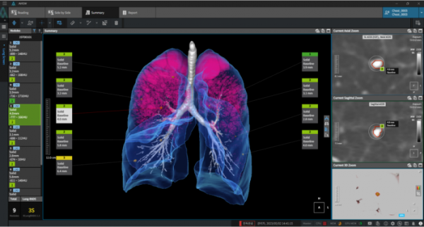 ▲코어라인소프트의 폐질환 제품 폐결절 자동 분석 소프트웨어 '에이뷰 엘씨에스(AVIEW LCS)' (사진제공=코어라인소프트)