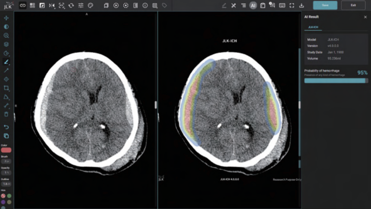 ▲제이엘케이의 뇌출혈 검출 솔루션 JLK-ICH. (사진제공=제이엘케이)