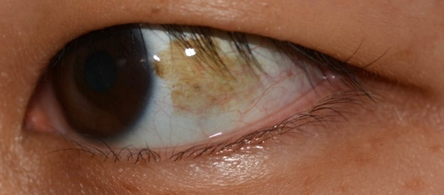 ▲결막모반이 눈 흰자위를 덮고 있는 결막 상피층에 넓게 퍼져 있다. (사진제공=김안과병원)