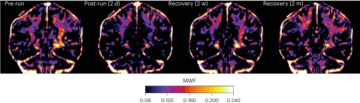 ▲마라톤 전후 뇌의 미엘린수분분획(MWF) 변화를 보여주는 자기공명영상(MRI) 데이터다. 직접 측정할 수 없는 미엘린 함량을 대신하는 지표인 MWF는 검은색에서 흰색으로 갈수록 높다. 경기 전(pre-run)에 비해 경기 이틀 뒤(post-run(2d)) MWF가 꽤 줄었고 2주 뒤(2w) 어느 정도 회복됐고 두 달 뒤(2m)에는 원래 수준으로 돌아왔다. 출처 ‘네이처 대사’