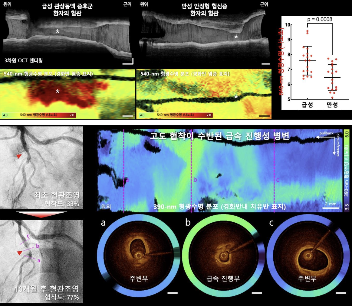 ▲(위)임상적 질환 상태별 관상동맥 동맥경화반의 염증 활성도 평가, (아래)급성 진행성 병변에서 광범위하게 분포하는 치유반 신호의 영상화 (고려대학교구로병원)