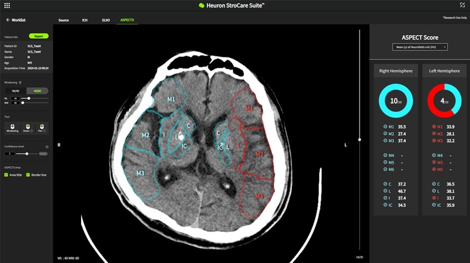 ▲ 휴런의 뇌졸중 진단 보조 AI 솔루션 휴런 스트로케어 스위트의 구동 화면. (사진제공=휴런)