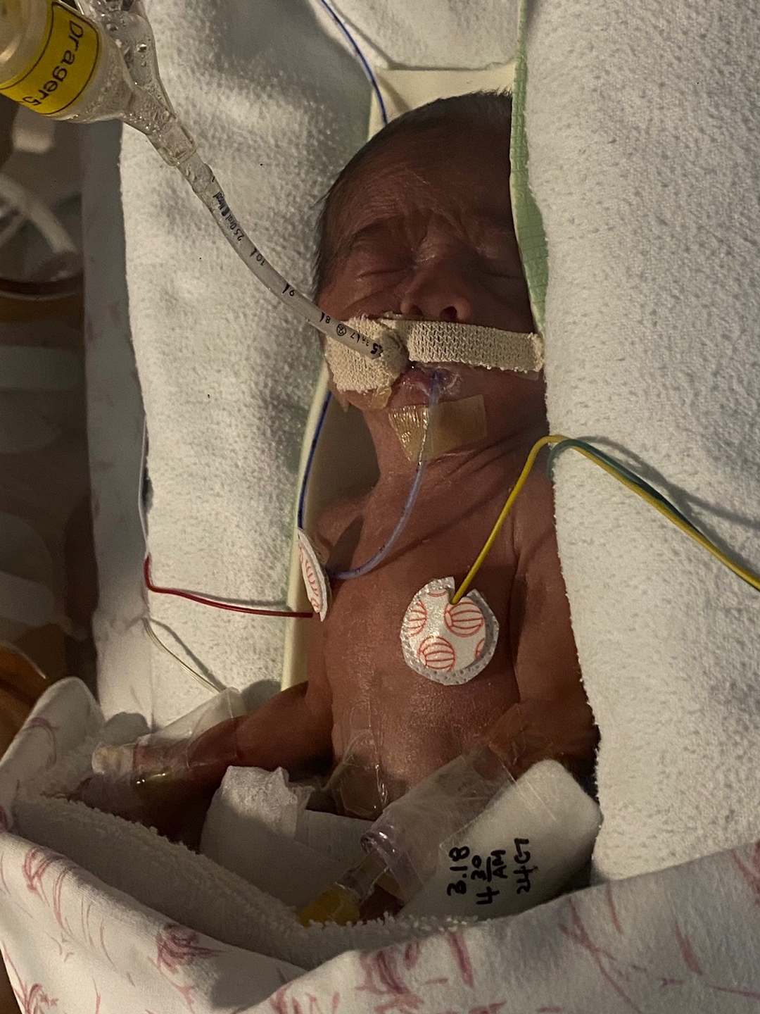 ▲환아(쩐푹안, 남)가 인큐베이터 안에서 치료를 받고 있다. (강릉아산병원)