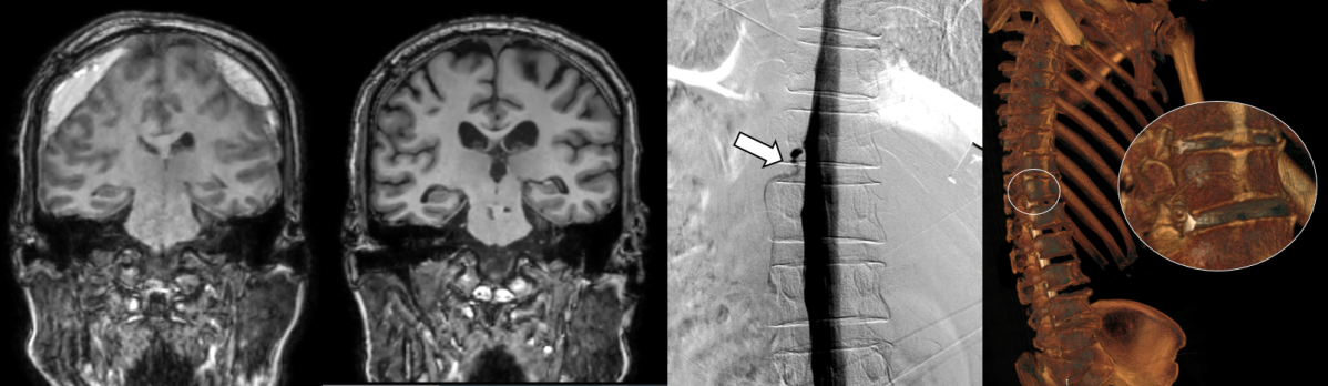 ▲(왼쪽) DSM으로 확인한 누공 위치, (오른쪽) 측위 CT 척수 조영술로 확인한 뇌척수액 정맥 누공 3D 영상 (세브란스병원)