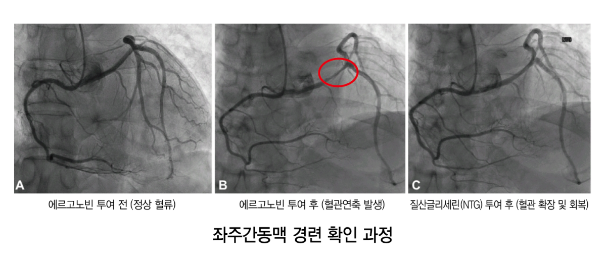 ▲좌주간동맥 경련 확인과정 (사진제공=온병원)