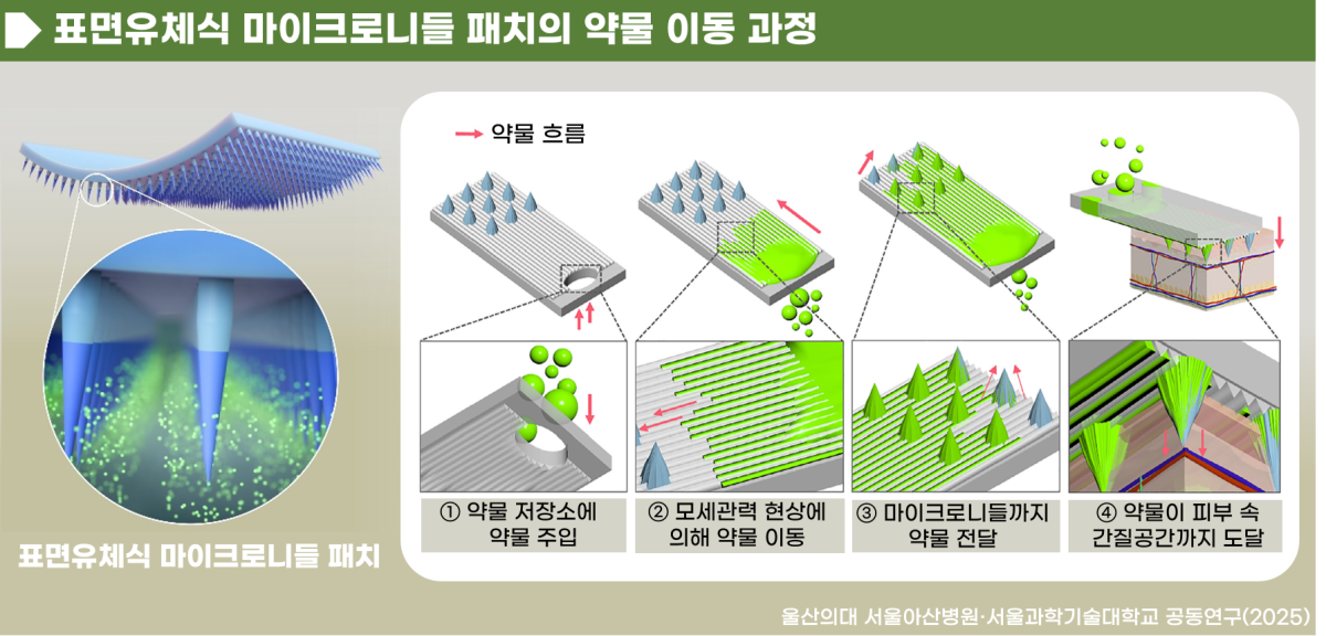 ▲표면유체식 마이크로니들 패치의 약물 이동 과정 (서울아산병원)
