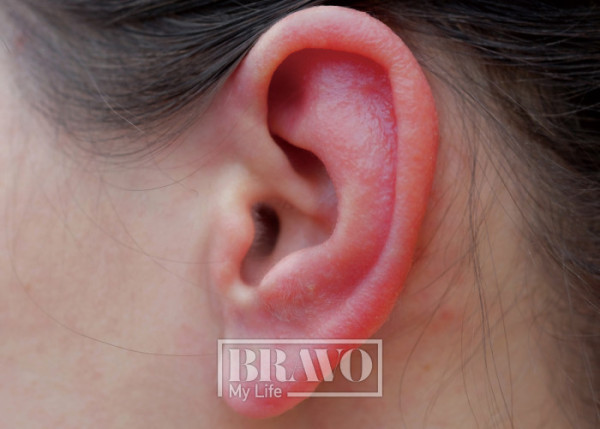 ▲귓속 털을 뽑다가 패혈증으로 이어진 임상 사진.(어도비 스톡)