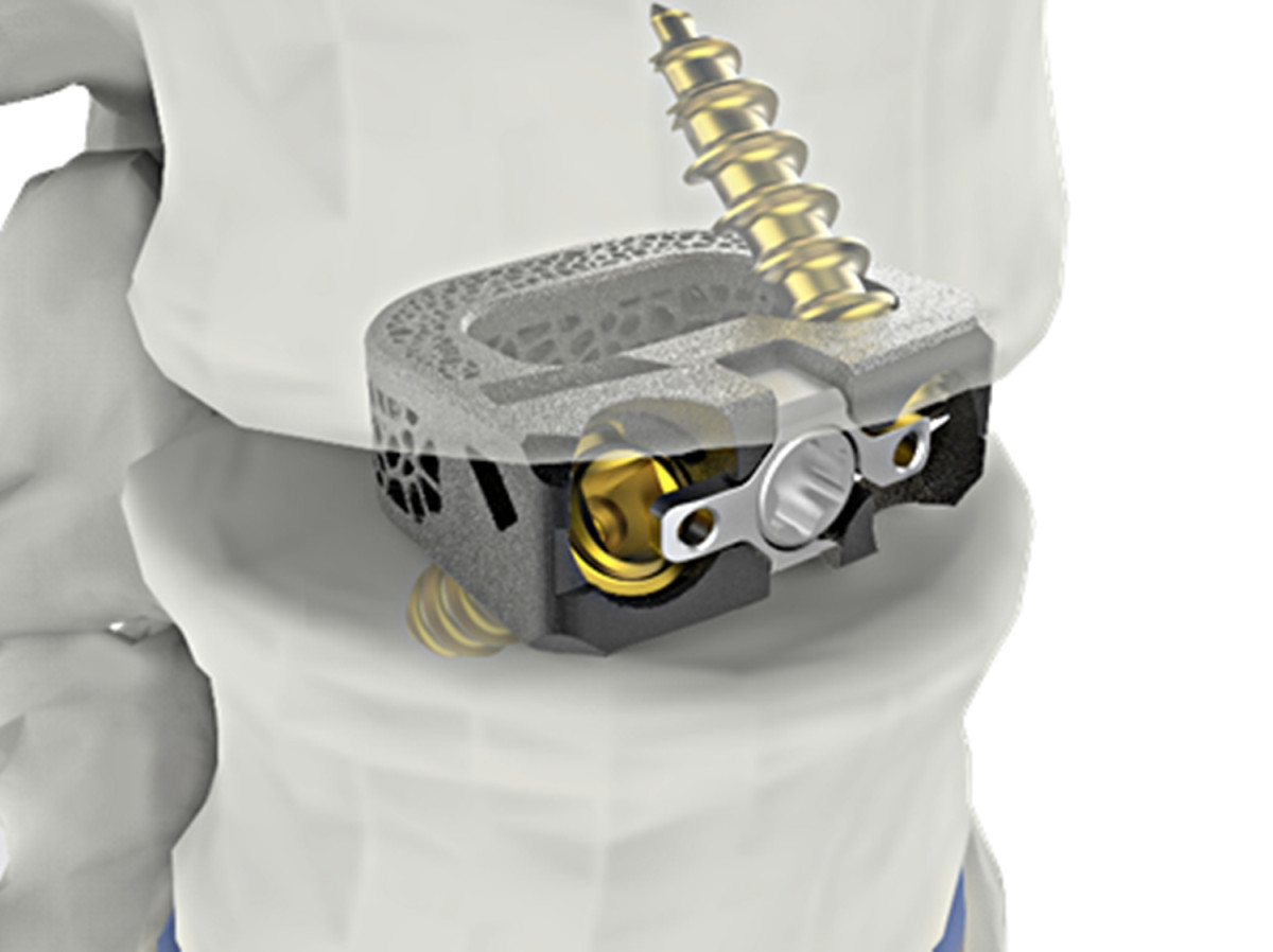 ▲시지메드텍의 척추 융합기기 ‘유니스페이스(UniSpace® TPLIF Cage, 요추 케이지)’. (사진제공=시지메드텍)