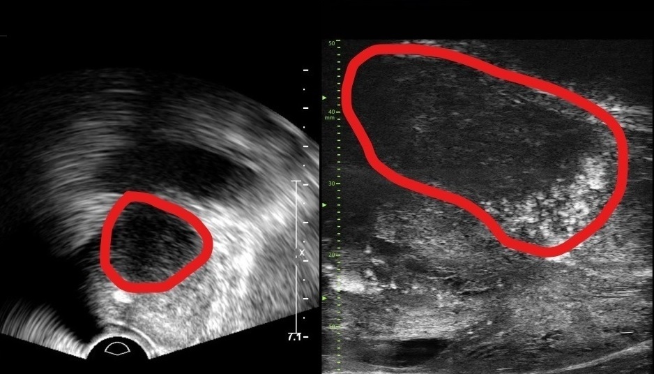▲기존 전립선 초음파 사진(좌) 및 최신 초음파 사진(우) (분당서울대병원)