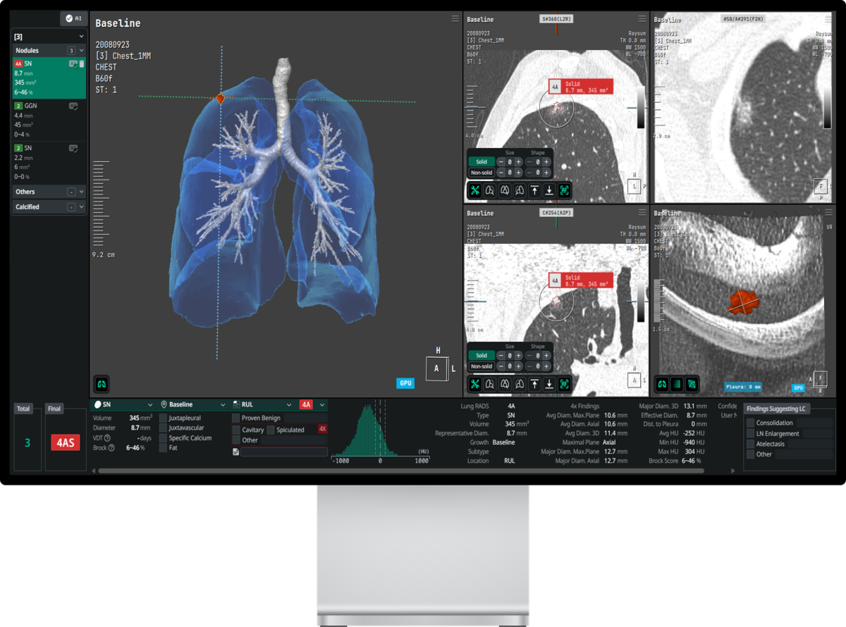 ▲코어라인소프트의 AI 흉부 진단 플랫폼 AVIEW LCS Plus. (사진제공=코어라인소프트)