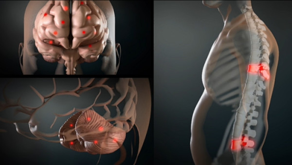 ▲'명의' 뇌암 (사진제공=EBS1 )