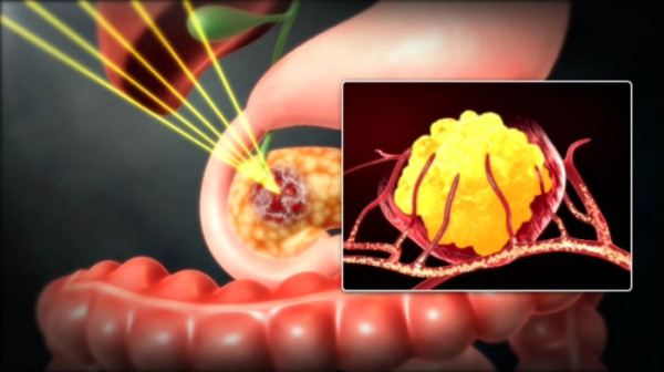 ▲'명의' 췌장암 (사진제공=EBS1 )