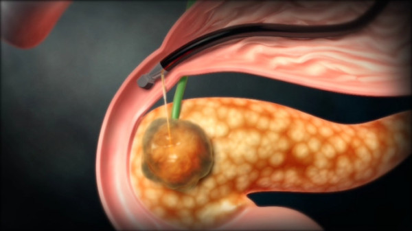 ▲'명의' 췌장암 (사진제공=EBS1 )
