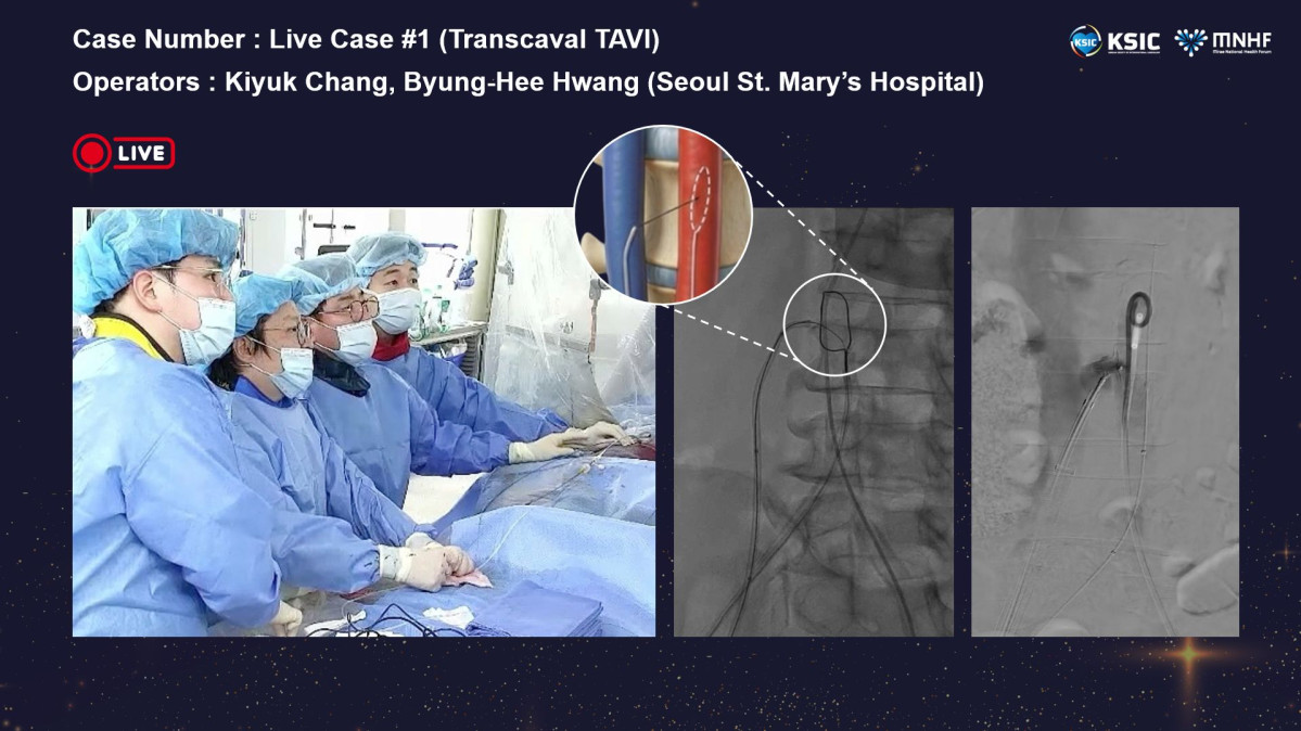 ▲서울성모병원 심뇌혈관병원 장기육 교수팀이 대한심혈관중재학회 라이브 시술로 국내 최초로 경대정맥 대동맥 판막 삽입술(Transcaval TAVI)을 진행하고 있다.  (서울성모병원)