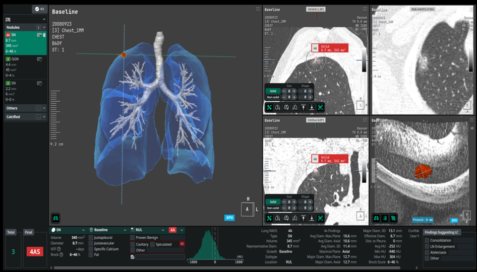 ▲인공지능(AI) 기반 영상 분석 소프트웨어 ‘AVIEW’ (사진제공=코어라인소프트)