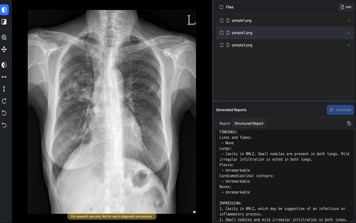 ▲숨빗AI가 개발한 생성형 AI 의료기기 AIRead-CXR . (사진제공=숨빗AI)