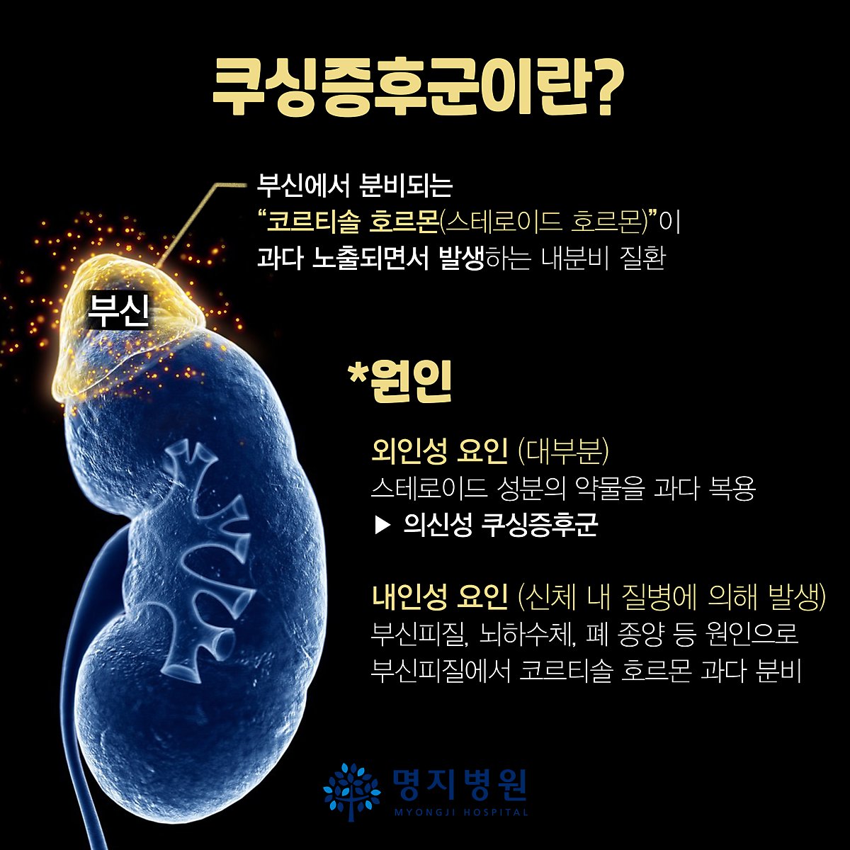 ▲쿠싱증후군에 대한 설명. (명지병원)