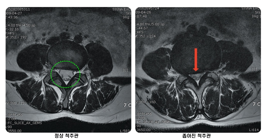 ▲빨간 화살표 부위의 척추관이 척추뼈가 내려앉은 영향으로 인하여 정상 상태(왼쪽 이미지)보다 좁아진 척추관협착증 소견이 관찰됐다.(자생한방병원)