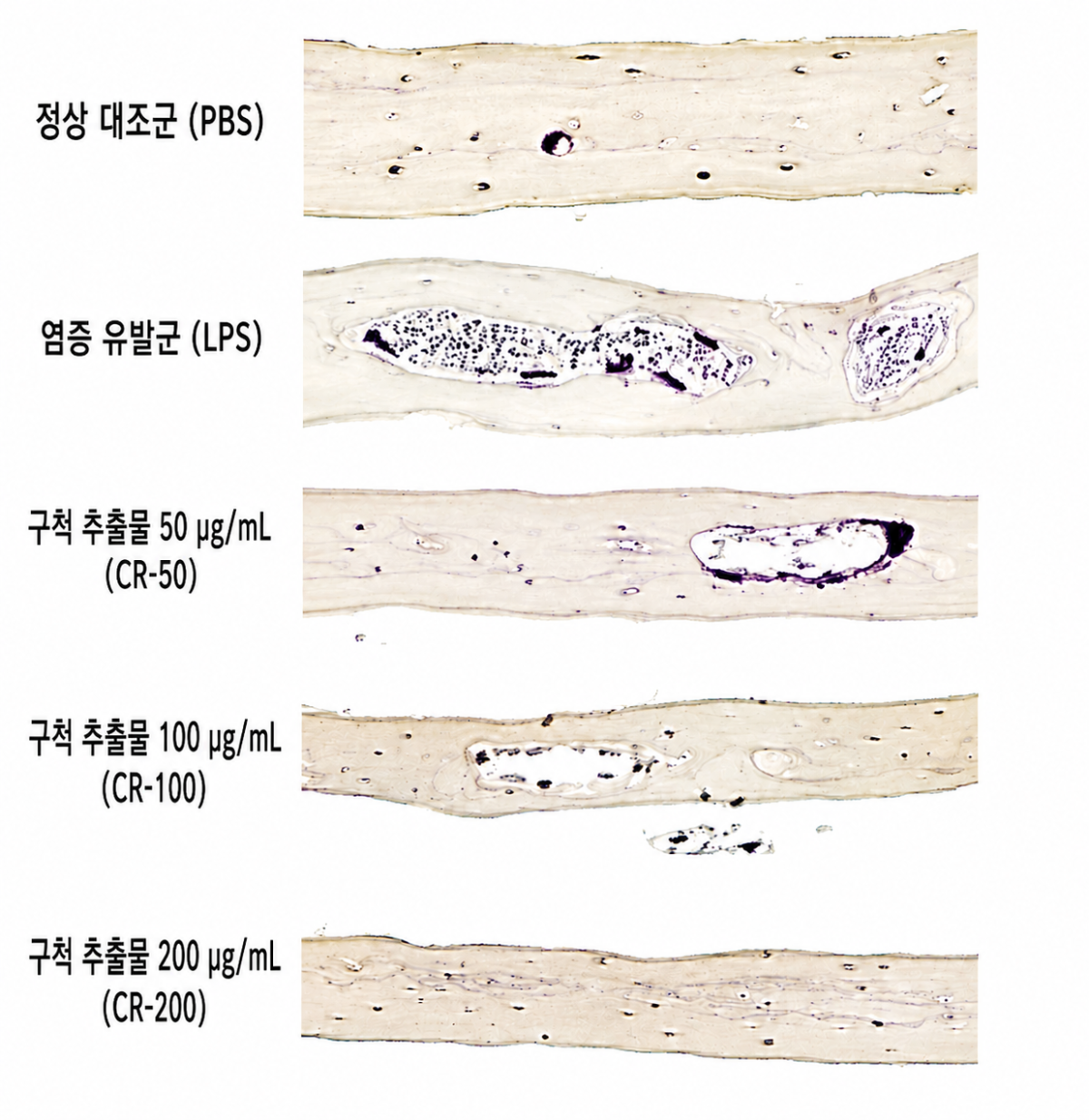 ▲실험쥐 머리뼈 조직 내 골 염증 유발군(LPS)에서 급증했던 파골세포(보라색)와 골미란 현상이 구척(CR) 추출물 투여 농도가 높아질수록 현저히 감소했으며, 최고 농도(CR-200)에서는 정상 대조군(PBS)과 유사한 수준으로 회복됐다.(자생한방병원)