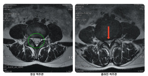 ▲빨간 화살표 부위의 척추관이 척추뼈가 내려앉은 영향으로 인하여 정상 상태(왼쪽 이미지)보다 좁아진 척추관협착증 소견이 관찰됐다.(자생한방병원)